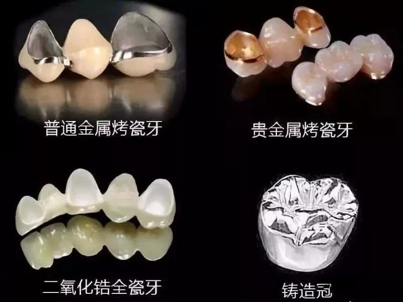 种植牙：重塑生命的微笑